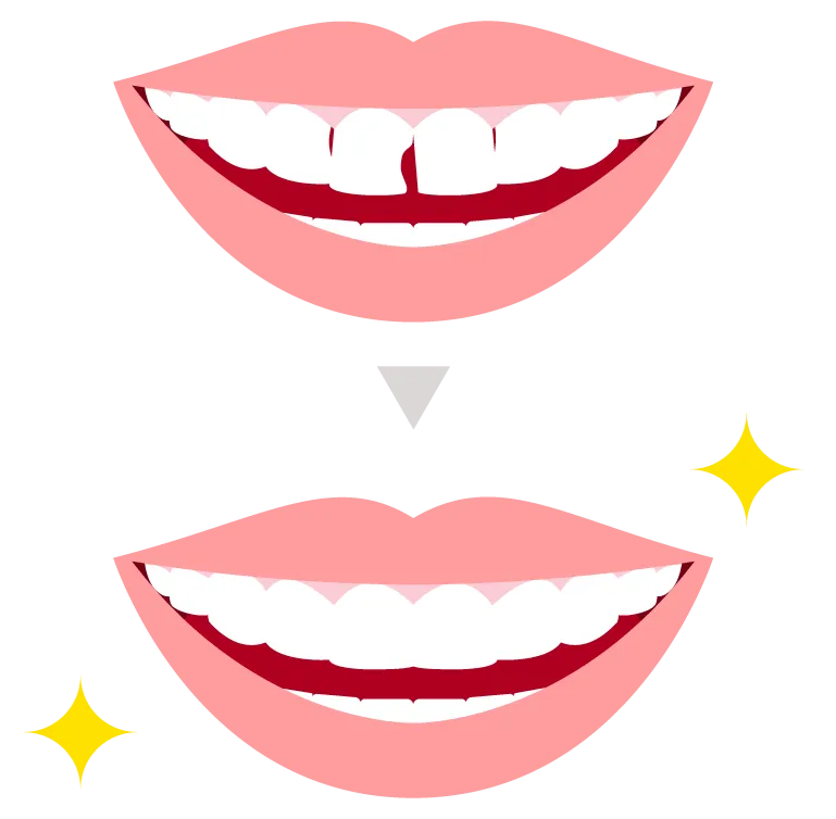 虫歯治療